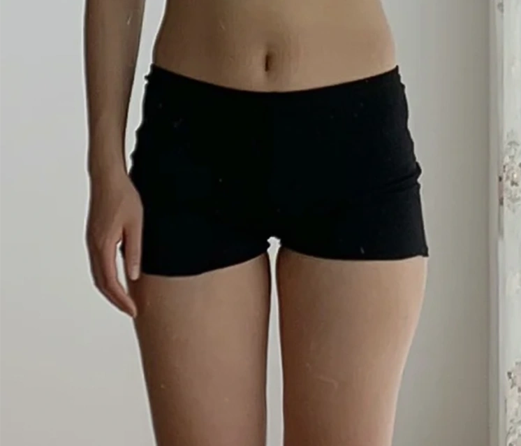 Before 6 sessions of combined Triple Body + BBAT Injection: actual PLAN;S Clinic lower abdomen & thighs case